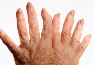Ревматоидный артрит – признаки и симптомы