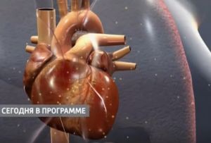 Как защититься от инфарктов
